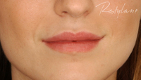 Lip Enhanacement London
